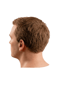 Norwood scale stage 1 hair loss progression