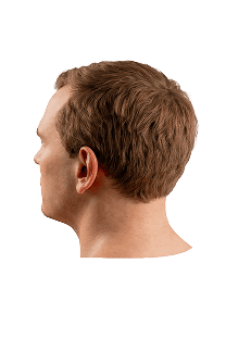 Norwood scale stage 2 hair loss progression