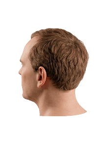 Norwood scale stage 3 hair loss progression
