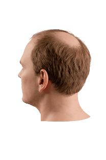 Norwood scale stage 4 hair loss progression