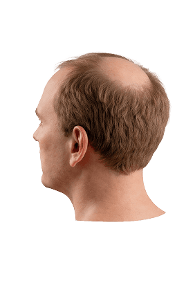 Norwood scale stage 5 hair loss progression