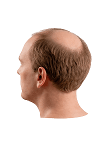 Norwood scale stage 6 hair loss progression