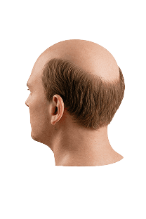 Norwood scale stage 7 hair loss progression