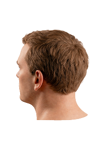 Norwood scale stage 1 hair loss progression