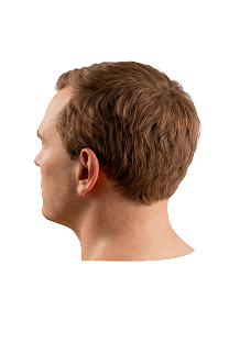 Norwood scale stage 2 hair loss progression