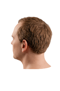 Norwood scale stage 3 hair loss progression