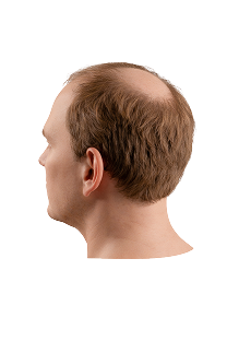 Norwood scale stage 4 hair loss progression