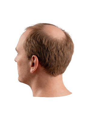 Male pattern hair loss on the back of a man’s head