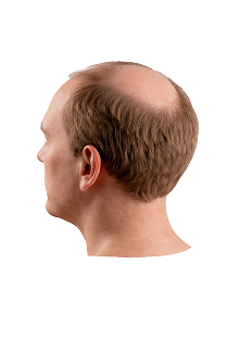 Norwood scale stage 6 hair loss progression