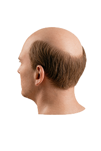 Norwood scale stage 7 hair loss progression